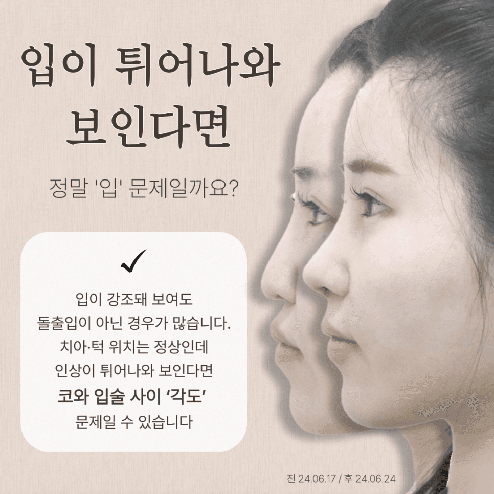 비순각수술 — 돌출입이 아닌데 입이 나와 보인다면 확인하는 각도 관련 이미지 2/8
