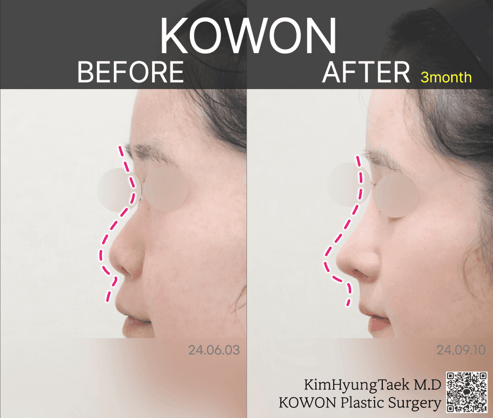 การผ่าตัดมุมระหว่างจมูกกับริมฝีปาก— ภาพที่เกี่ยวข้องกับมุมเพื่อตรวจสอบว่าปากดูยื่นออกมาหรือไม่ แม้ว่าจะไม่มีการยื่นออกมาจริงก็ตาม 5/8