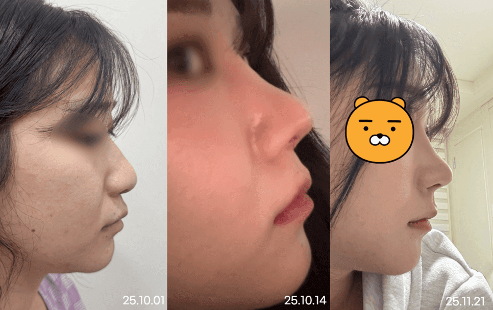 비순각수술 — 돌출입이 아닌데 입이 나와 보인다면 확인하는 각도 관련 이미지 7/8