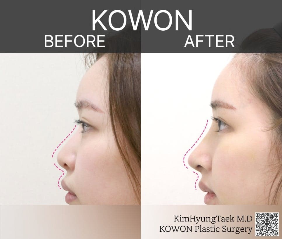 비순각성형과 고양이수술, 어떻게 다른가요 — 삽입 없는 교정과 수술 후 웃을 때 어색함 Q&A 관련 이미지 2/5
