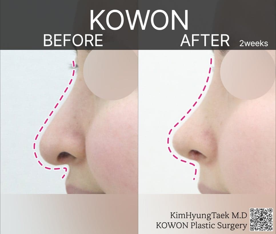 비순각성형과 고양이수술, 어떻게 다른가요 — 삽입 없는 교정과 수술 후 웃을 때 어색함 Q&A 관련 이미지 3/5