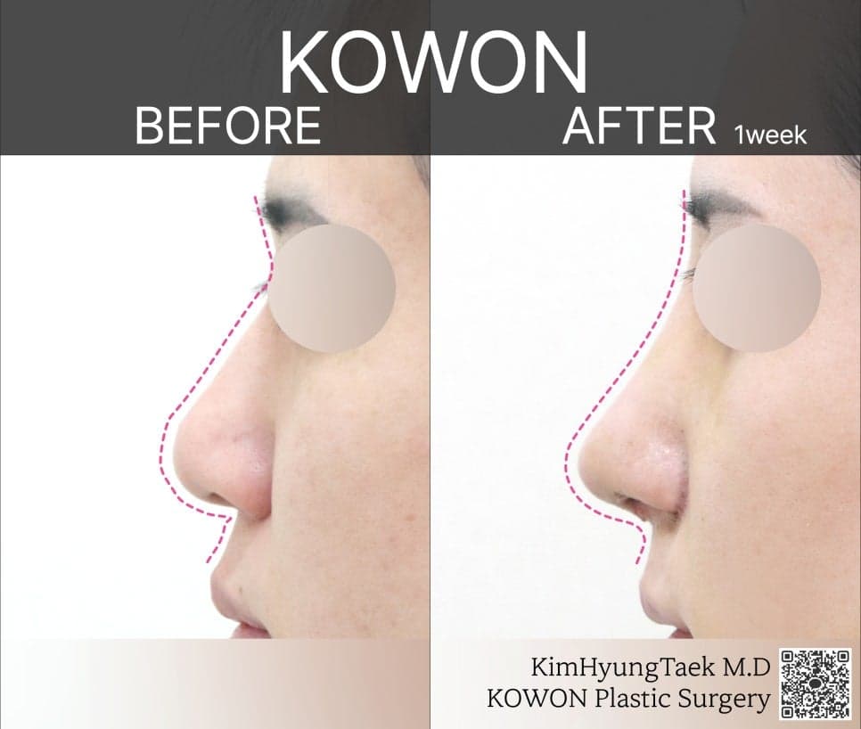 비순각성형과 고양이수술, 어떻게 다른가요 — 삽입 없는 교정과 수술 후 웃을 때 어색함 Q&A 관련 이미지 4/5