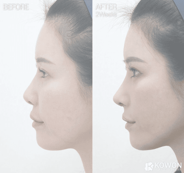 비순각성형과 고양이수술, 어떻게 다른가요 — 삽입 없는 교정과 수술 후 웃을 때 어색함 Q&A 관련 이미지 5/5