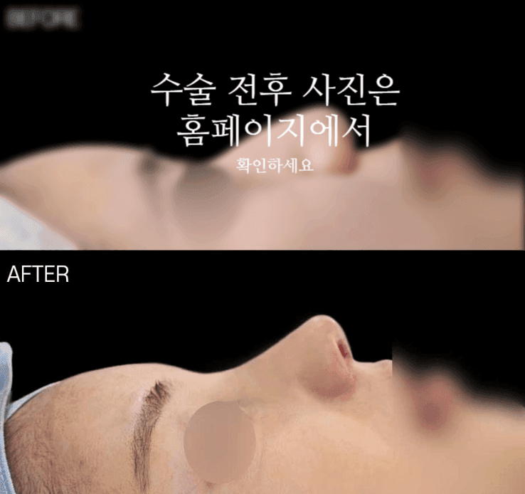 비순각교정과 단순 코높임은 무엇이 다른가요 — 코끝부터 인중까지 흐름을 보는 이유 관련 이미지 2/9