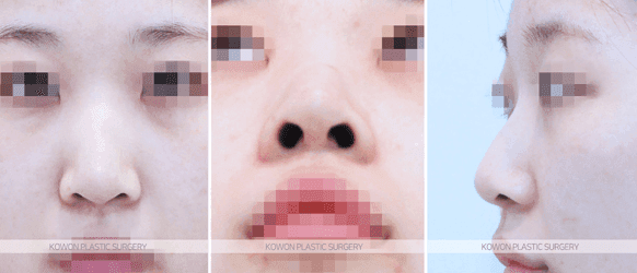 비순각교정과 단순 코높임은 무엇이 다른가요 — 코끝부터 인중까지 흐름을 보는 이유 관련 이미지 4/9