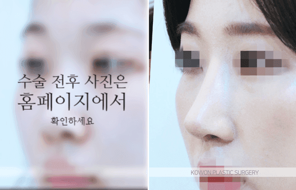 비순각교정과 단순 코높임은 무엇이 다른가요 — 코끝부터 인중까지 흐름을 보는 이유 관련 이미지 5/9