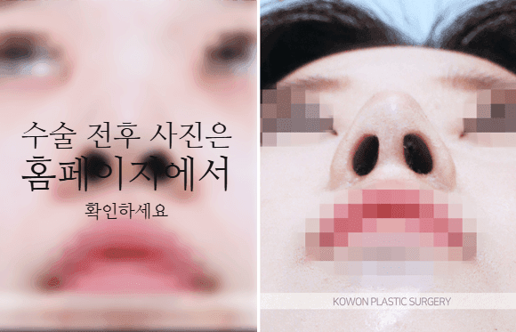 비순각교정과 단순 코높임은 무엇이 다른가요 — 코끝부터 인중까지 흐름을 보는 이유 관련 이미지 6/9