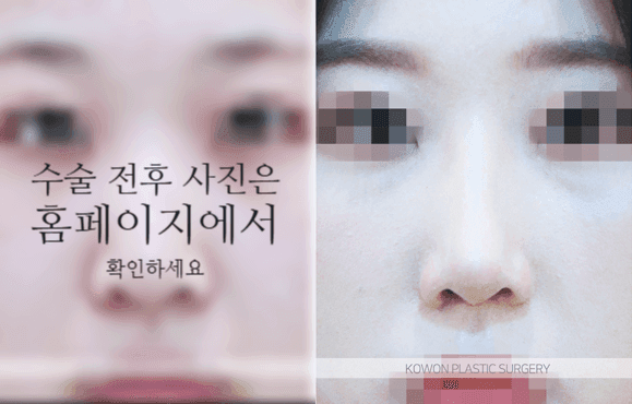 비순각교정과 단순 코높임은 무엇이 다른가요 — 코끝부터 인중까지 흐름을 보는 이유 관련 이미지 7/9