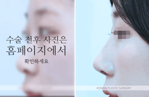 비순각교정과 단순 코높임은 무엇이 다른가요 — 코끝부터 인중까지 흐름을 보는 이유 관련 이미지 8/9