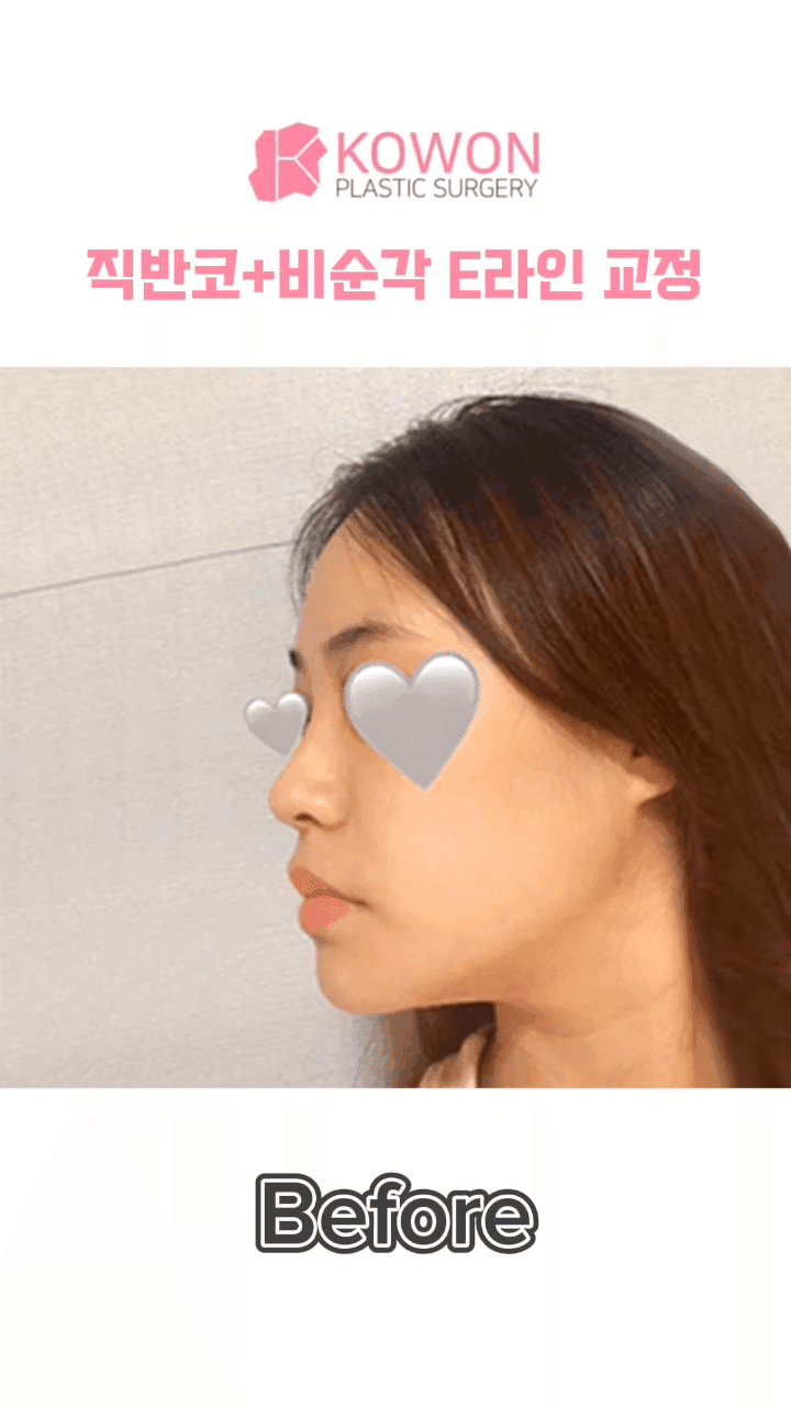 비순각수술 후 코보형물 움직임·비주붓기, 지켜봐도 될까 — 확인이 필요한 신호 관련 이미지 7/12