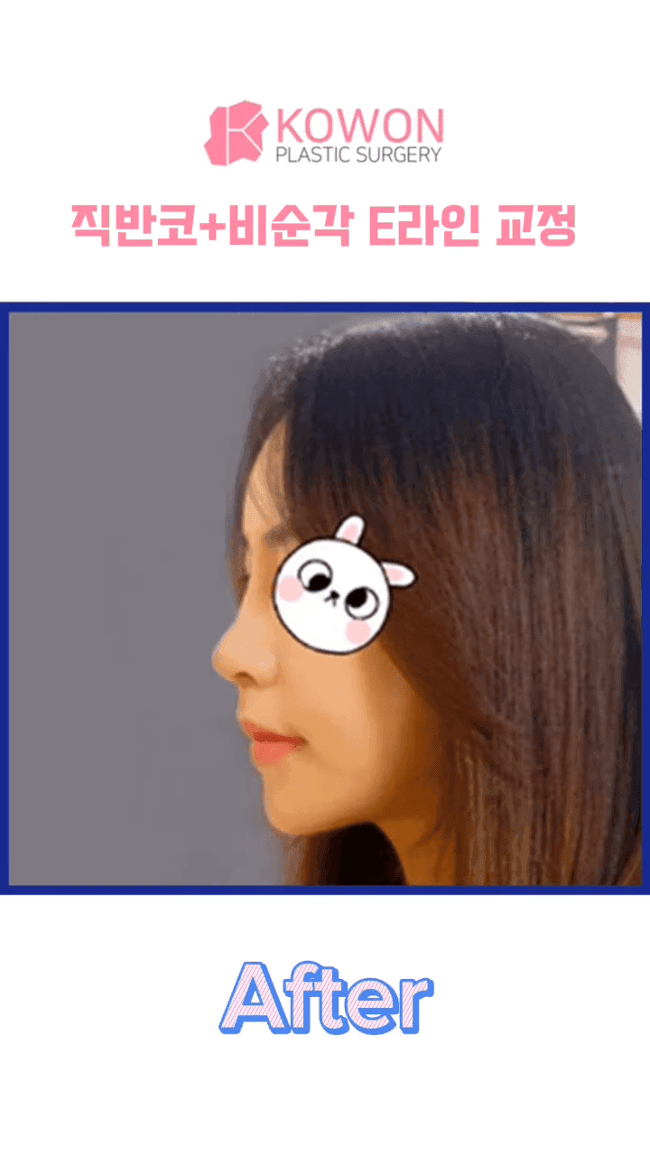비순각수술 후 코보형물 움직임·비주붓기, 지켜봐도 될까 — 확인이 필요한 신호 관련 이미지 8/12