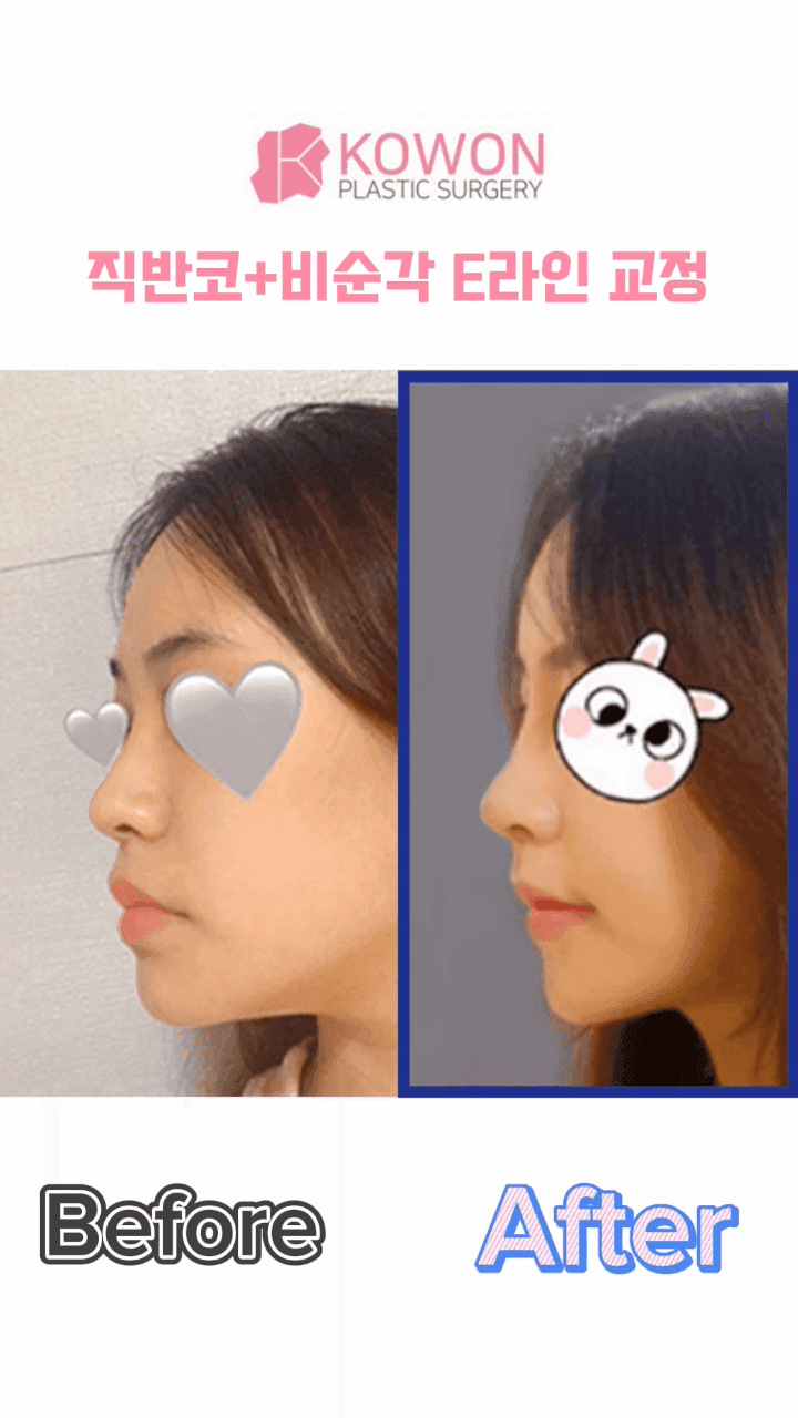 Image 9/12 for: implant movement and columella swelling after nasolabial-angle surgery