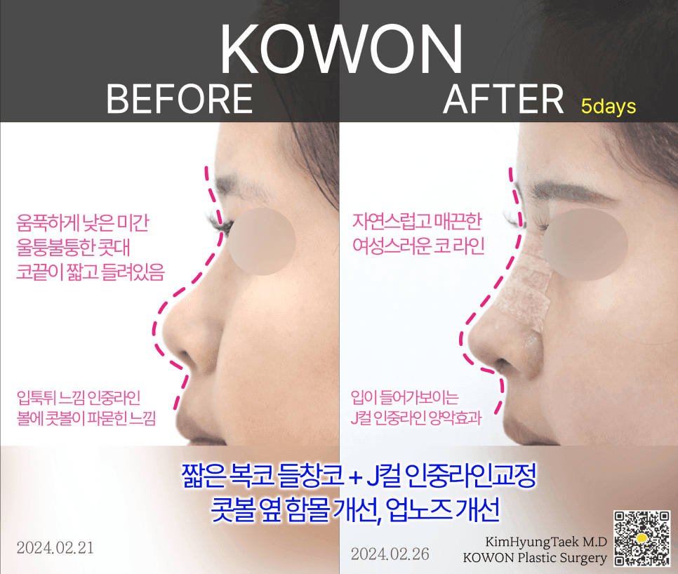 자연스러운 코의 조건 — 이마 라인·정면 비율·비순각, 세 가지를 함께 보는 이유 관련 이미지 5/6
