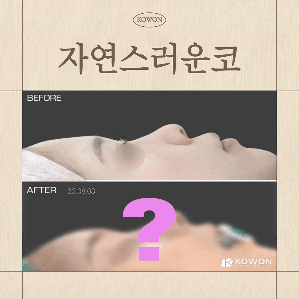 อนุภาคกระดูกอ่อนซี่โครงของตนเองเพื่อจมูกที่ดูเป็นธรรมชาติ — วัสดุและเกณฑ์ในการพิจารณาโครงสร้าง RIBFIT™ภาพที่เกี่ยวข้อง 1/8