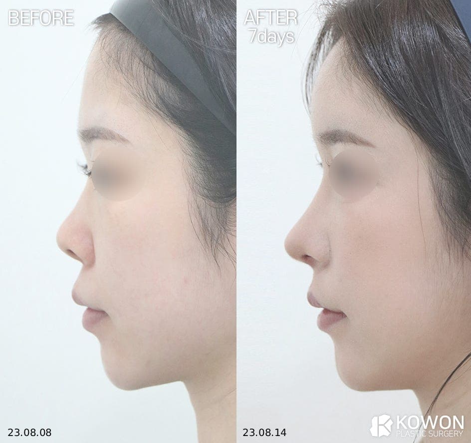 자연스러운 코를 만드는 자가늑입자 — 재료와 RIBFIT™ 리브핏 구조를 보는 기준 관련 이미지 3/8