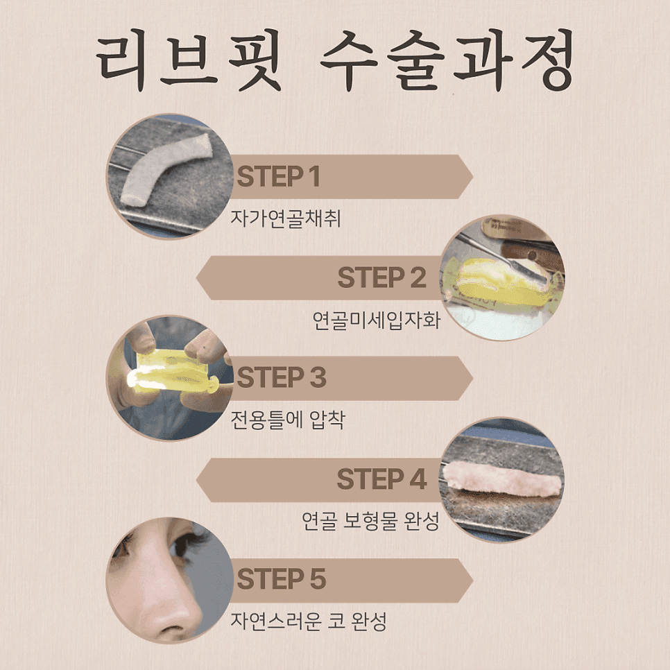 자연스러운 코를 만드는 자가늑입자 — 재료와 RIBFIT™ 리브핏 구조를 보는 기준 관련 이미지 5/8