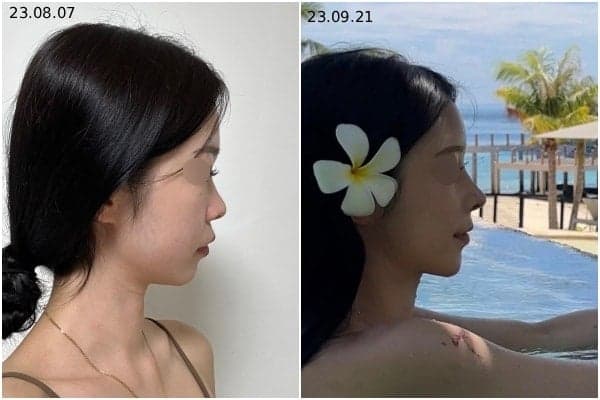 자연스러운 코를 만드는 자가늑입자 — 재료와 RIBFIT™ 리브핏 구조를 보는 기준 관련 이미지 8/8