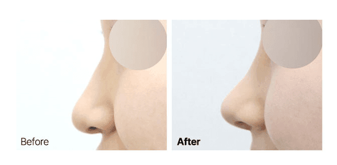 티 안 나는 코성형이 목표라면 — 보형물 없이 코끝만 정리하는 방법과 RIBFIT™ 리브핏 관련 이미지 8/12