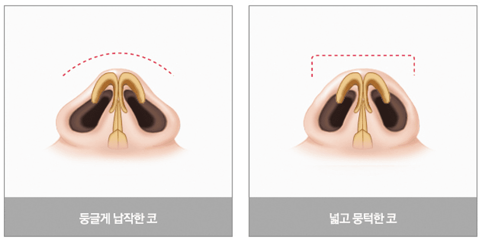 비절개 코수술로 복코 교정, 얼마나 높일까보다 조화가 먼저인 이유 관련 이미지 2/8