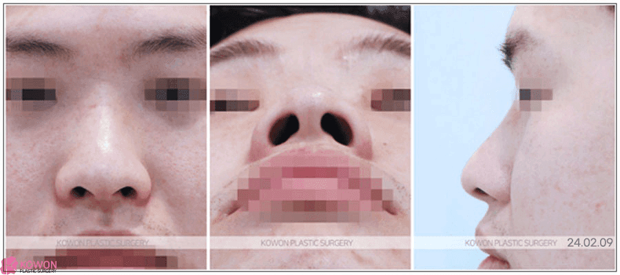 การแก้ไขปลายจมูกกลมใหญ่ด้วยการผ่าตัดจมูกแบบไม่กรีด: เหตุใดความกลมกลืนจึงสำคัญกว่าการยกปลายจมูกขึ้นมากแค่ไหน - ภาพที่เกี่ยวข้อง 3/8