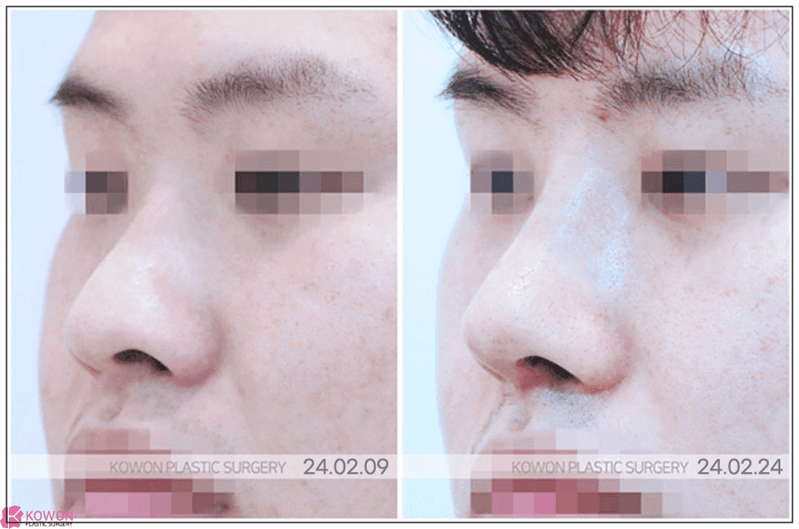 การแก้ไขปลายจมูกกลมใหญ่ด้วยการผ่าตัดจมูกแบบไม่กรีด: เหตุใดความกลมกลืนจึงสำคัญกว่าการยกปลายจมูกขึ้นมากน้อยแค่ไหน - ภาพประกอบที่เกี่ยวข้อง 4/8