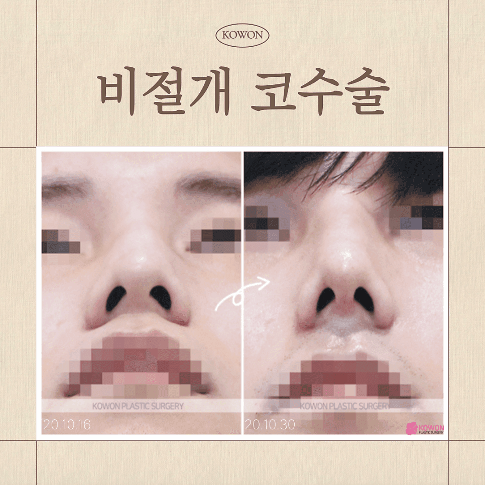 การผ่าตัดจมูกแบบไม่กรีด กับการผ่าตัดจมูกแบบปิด: แตกต่างกันอย่างไร? — เกณฑ์การเลือกเพื่อสร้างรูปทรงจมูกที่ไร้รอยแผลเป็น ภาพประกอบ 1/8