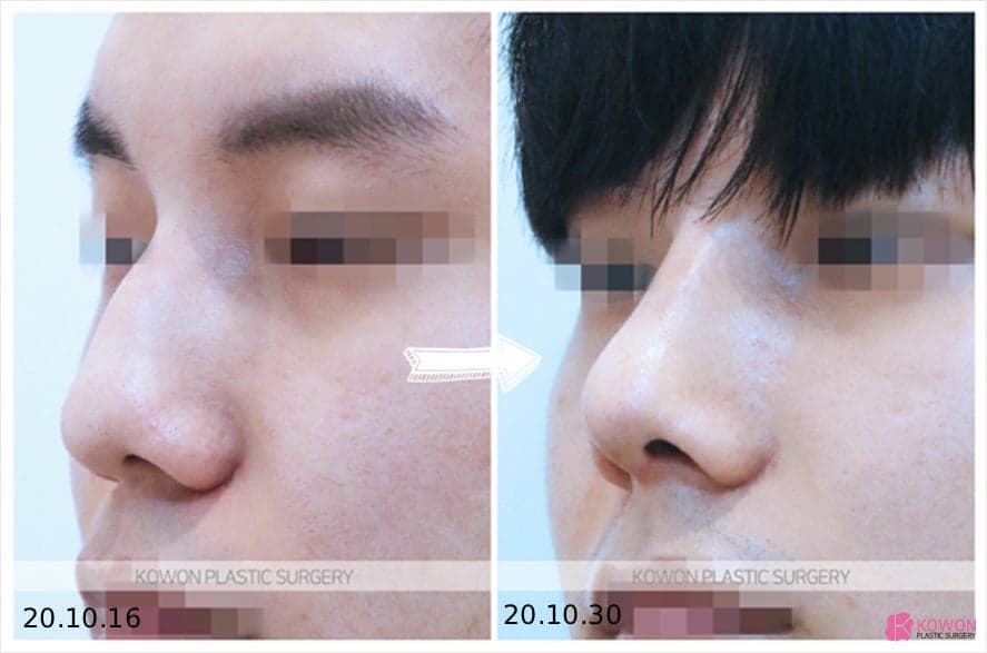 비절개 코수술과 비개방 코수술, 무엇이 다른가 — 흉터 없이 라인을 만드는 선택 기준 관련 이미지 3/8