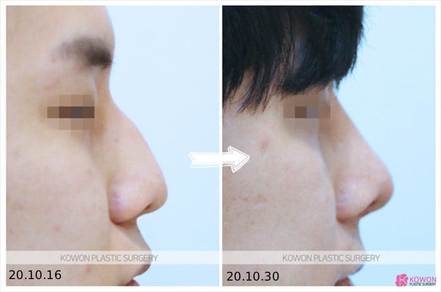비절개 코수술과 비개방 코수술, 무엇이 다른가 — 흉터 없이 라인을 만드는 선택 기준 관련 이미지 6/8