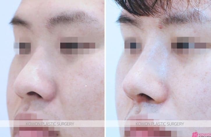 코수술 후 코막힘에 코를 풀었더니 이물질이 나왔다면 — 확인 순서 관련 이미지 4/5