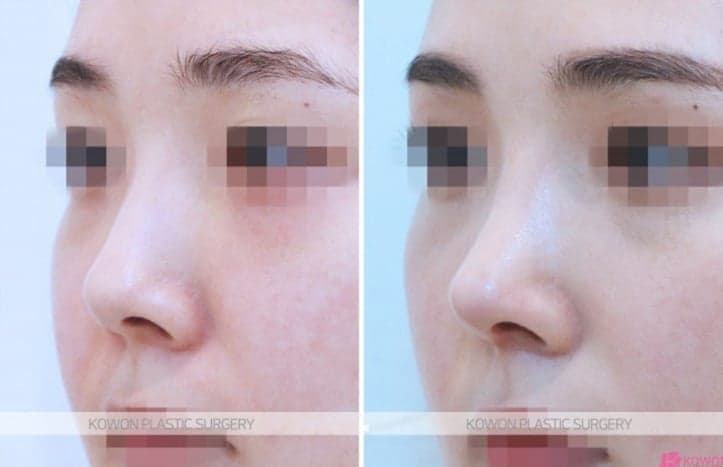 코수술 후 코막힘에 코를 풀었더니 이물질이 나왔다면 — 확인 순서 관련 이미지 5/5
