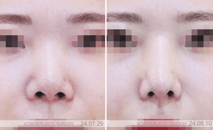 콧대높이기, 높이보다 비율 — 얼굴 조화를 먼저 보는 이유 관련 이미지 3/7