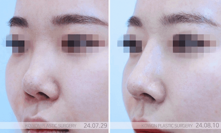 콧대높이기, 높이보다 비율 — 얼굴 조화를 먼저 보는 이유 관련 이미지 4/7