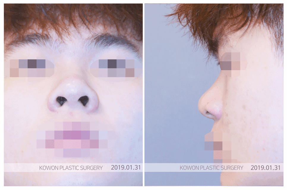 콧대수술 전 확인 — 콧대가 낮아 보이는 이유는 높이 때문만이 아닙니다 관련 이미지 2/6
