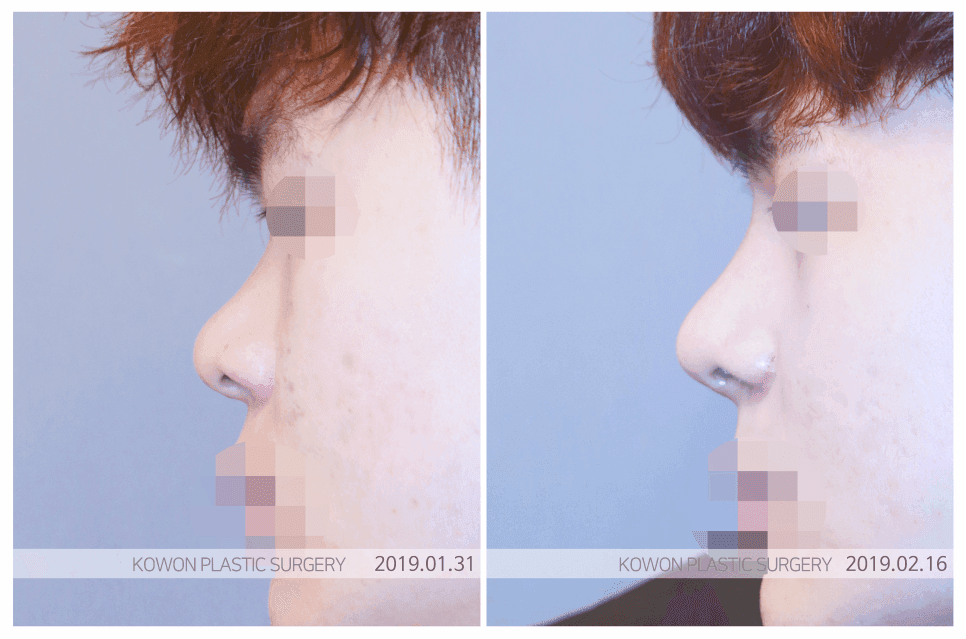 콧대수술 전 확인 — 콧대가 낮아 보이는 이유는 높이 때문만이 아닙니다 관련 이미지 5/6