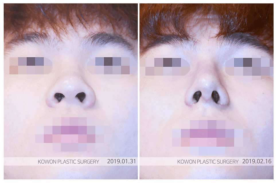 콧대수술 전 확인 — 콧대가 낮아 보이는 이유는 높이 때문만이 아닙니다 관련 이미지 6/6