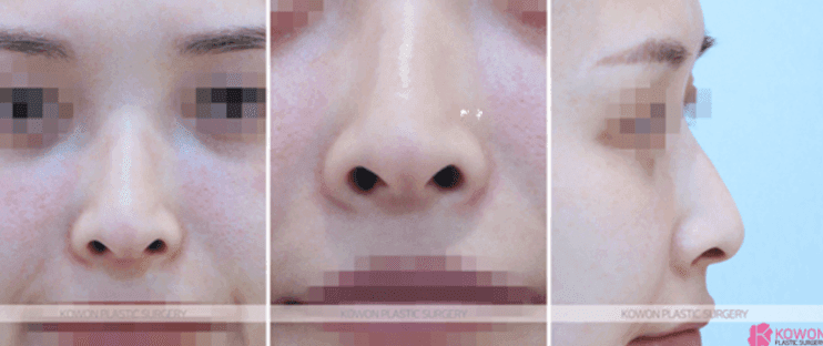 콧대 실리콘 4mm는 티가 날까 — 수치보다 얼굴 균형을 먼저 보는 이유 관련 이미지 4/10