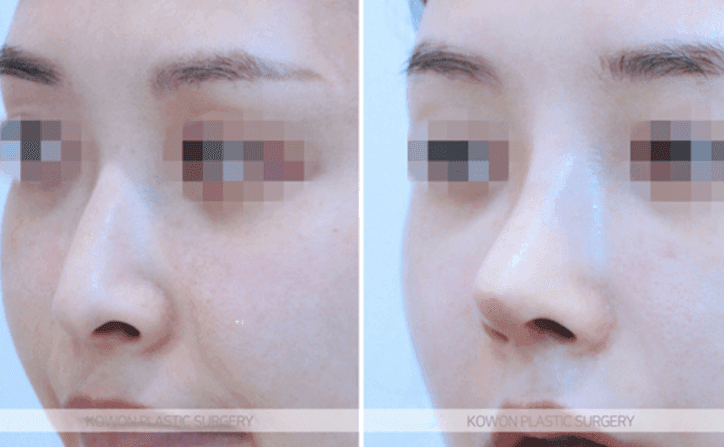콧대 실리콘 4mm는 티가 날까 — 수치보다 얼굴 균형을 먼저 보는 이유 관련 이미지 6/10