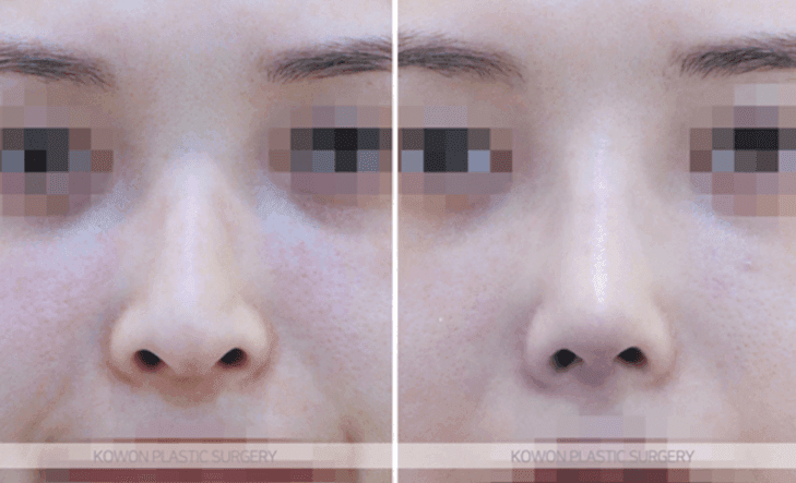 콧대 실리콘 4mm는 티가 날까 — 수치보다 얼굴 균형을 먼저 보는 이유 관련 이미지 8/10