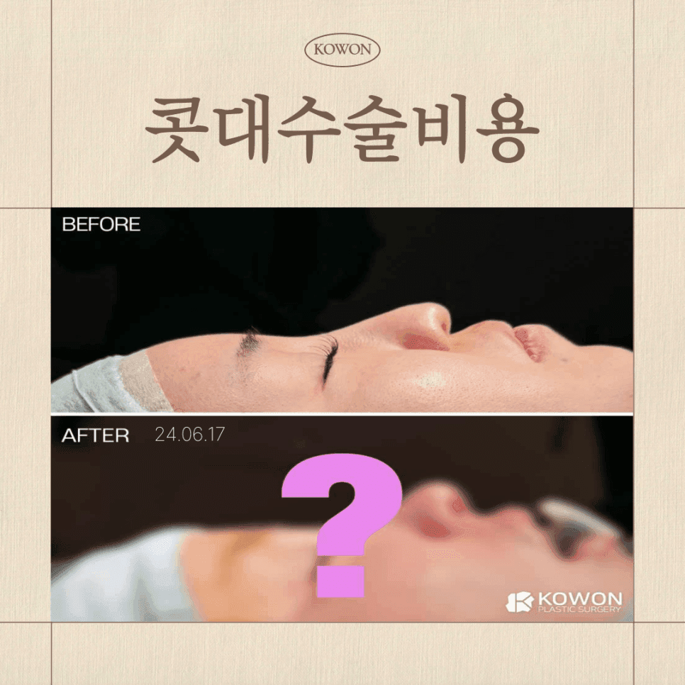 콧대수술비용은 왜 병원마다 다를까 — 난이도·재료·관리 시스템으로 나눠 보는 기준 관련 이미지 1/4