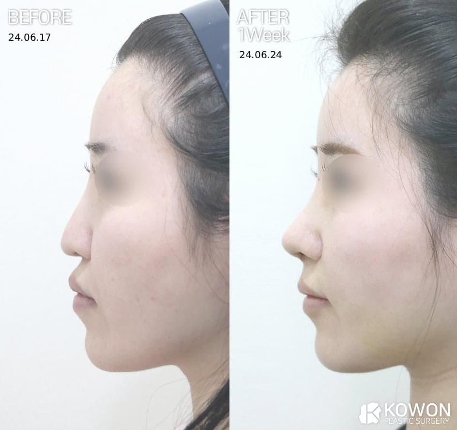 콧대수술비용은 왜 병원마다 다를까 — 난이도·재료·관리 시스템으로 나눠 보는 기준 관련 이미지 2/4
