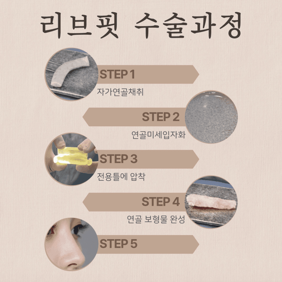 콧대수술비용은 왜 병원마다 다를까 — 난이도·재료·관리 시스템으로 나눠 보는 기준 관련 이미지 3/4