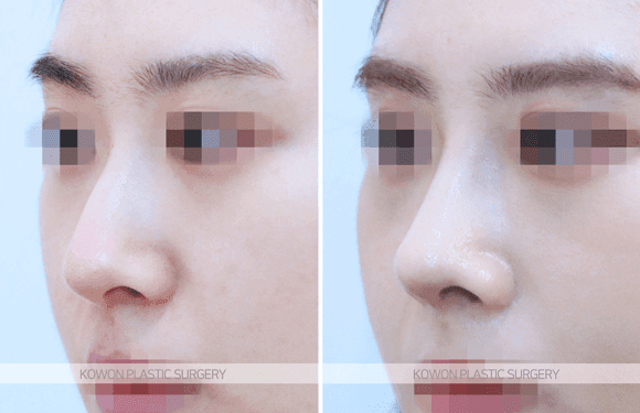 สามารถปรับปลายจมูกทู่ให้ดูเรียวขึ้นได้ด้วยการฉีดสลายไขมันที่จมูกหรือไม่? — เกณฑ์ในการแยกแยะระหว่างการฉีดและการผ่าตัด ภาพที่ 4/7