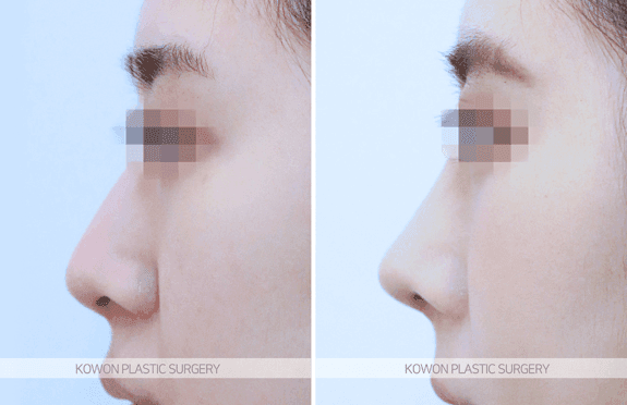 Image 5/7 for: nose fat-dissolving injection vs tip surgery