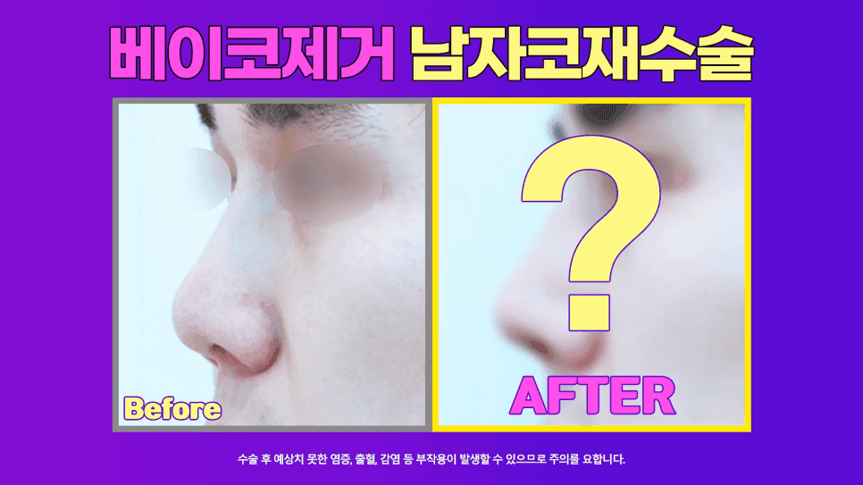 코필러·실 제거 후 재수술 — 쁘띠성형 흔적은 왜 먼저 제거해야 하나요? 관련 이미지 1/9