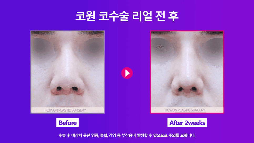 코필러·실 제거 후 재수술 — 쁘띠성형 흔적은 왜 먼저 제거해야 하나요? 관련 이미지 6/9