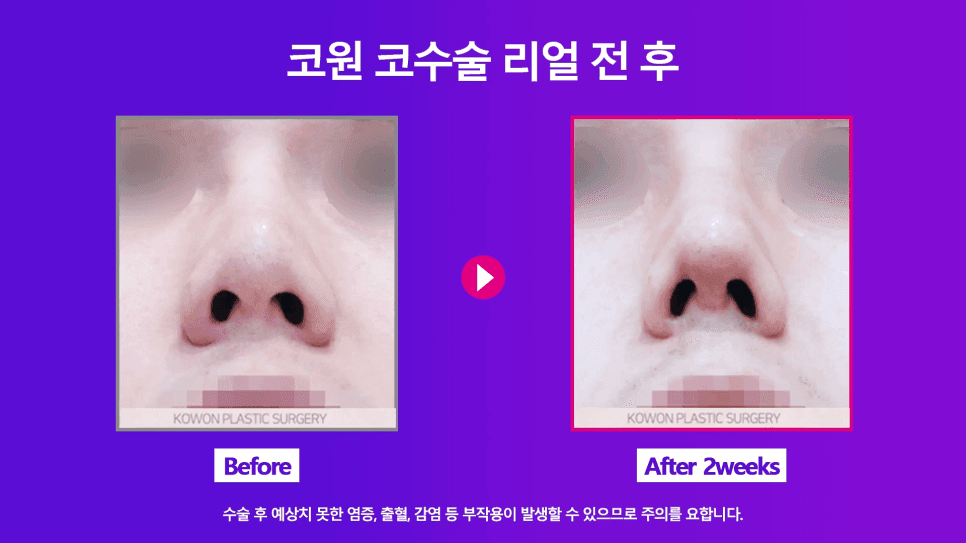 ฟิลเลอร์จมูก· การผ่าตัดแก้ไขหลังการเอาไหมเย็บออก — เหตุใดจึงต้องเอาเศษร่องรอยจากการทำศัลยกรรมเสริมความงามเล็กๆ น้อยๆ ออกก่อน? ภาพที่เกี่ยวข้อง 7/9