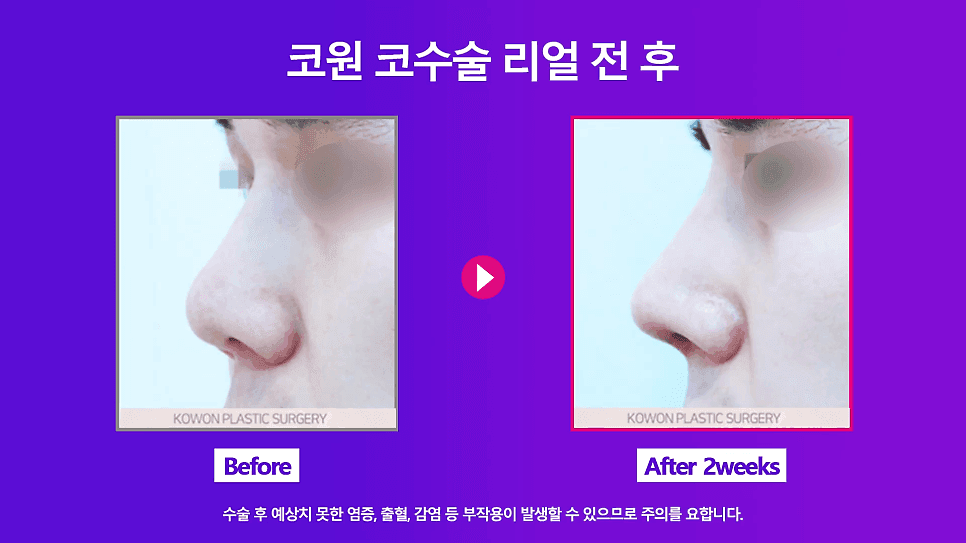 코필러·실 제거 후 재수술 — 쁘띠성형 흔적은 왜 먼저 제거해야 하나요? 관련 이미지 9/9