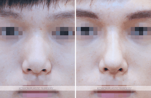 코수술 1년 뒤 코를 부딪혔다면 — 괜찮은 경우와 검사가 필요한 신호 관련 이미지 3/5