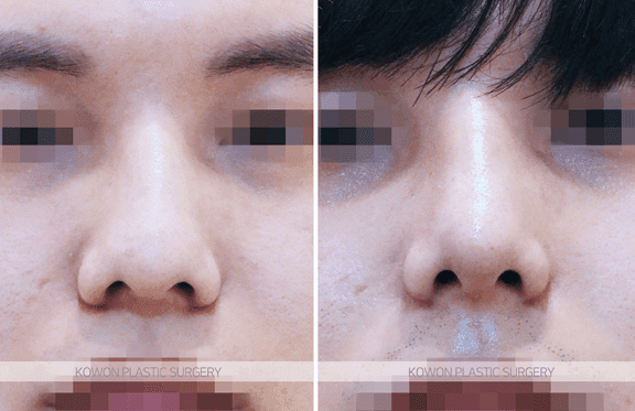 코수술 1년 뒤 코를 부딪혔다면 — 괜찮은 경우와 검사가 필요한 신호 관련 이미지 4/5