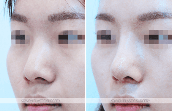 코수술 1년 뒤 코를 부딪혔다면 — 괜찮은 경우와 검사가 필요한 신호 관련 이미지 5/5